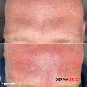 brežžična naprava za microneedling