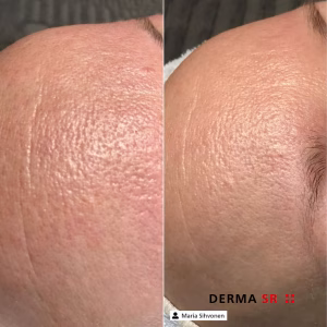 brežžična naprava za microneedling